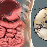 Infezione da Helicobacter pylori: sintomi + 9 trattamenti naturali