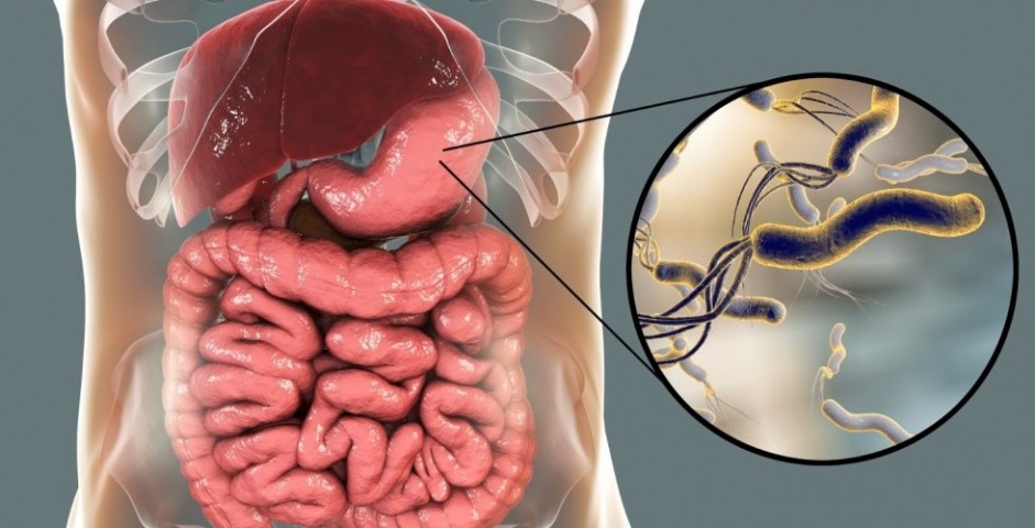 Infezione da Helicobacter pylori: sintomi + 9 trattamenti naturali