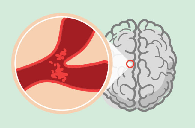 5 semplici consigli per prevenire l’ictus