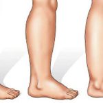 Come eliminare l’eccesso di acqua dal corpo in modo naturale