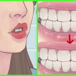 Come smettere di digrignare i denti nel sonno