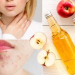 Acido acetico: un composto potente dell’aceto con benefici per la salute, utilizzi ed effetti collaterali