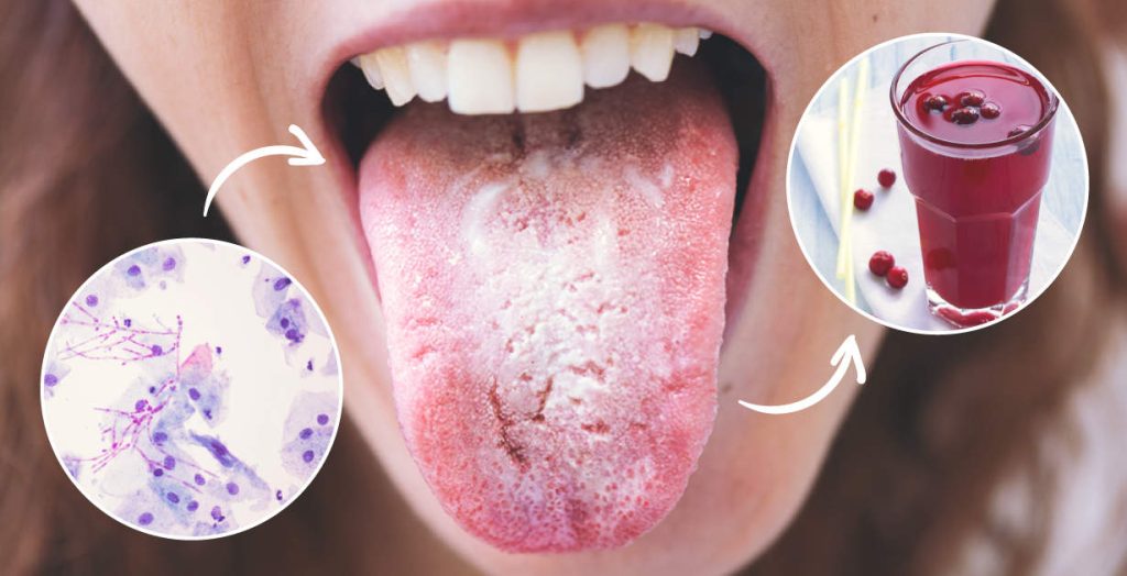 Candida: cos’è, perché appare, quali sono i sintomi e come liberarsene