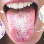 Candida: cos’è, perché appare, quali sono i sintomi e come liberarsene