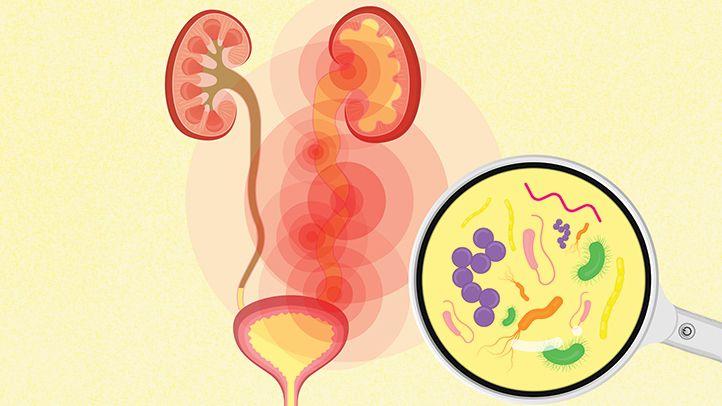 Trattare le infezioni urinarie in modo naturale: Rimedi efficaci per un comfort rapido