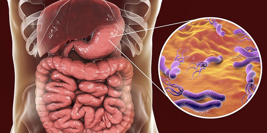Infezione da Helicobacter pylori: cause, sintomi, rimedi naturali