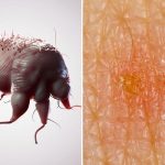 Scabbia: 7 trattamenti naturali che funzionano rapidamente