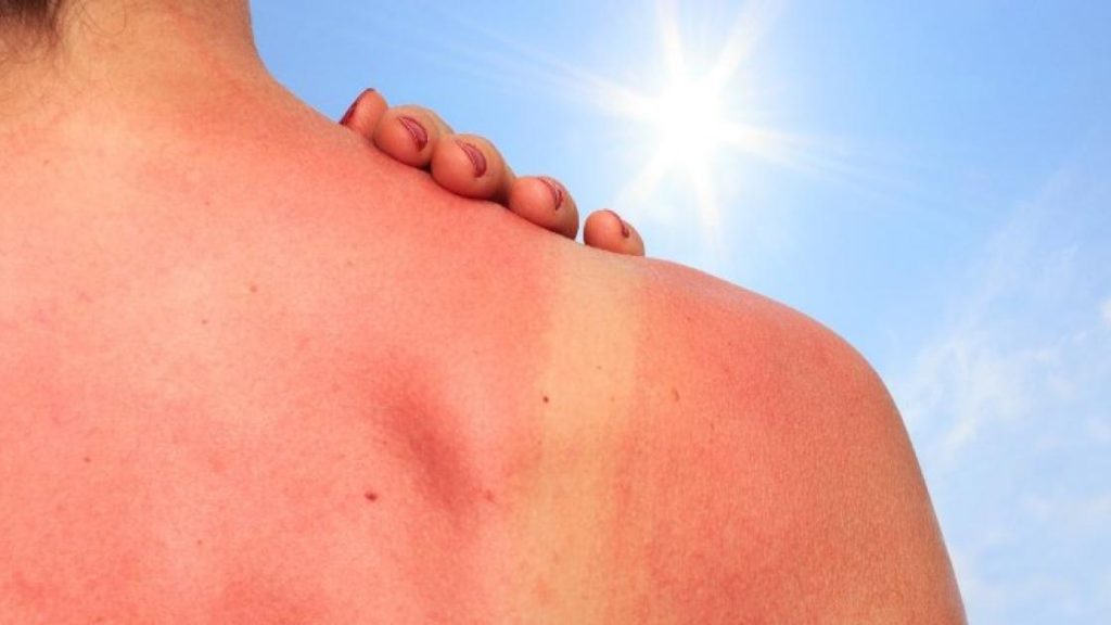 Come trattare naturalmente le scottature solari: 16 rimedi molto utili