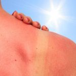 Come trattare naturalmente le scottature solari: 16 rimedi molto utili