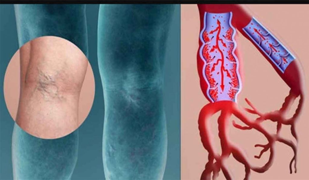 Trombosi venosa profonda (TVP) cause, fattori di rischio, sintomi e trattamenti naturali