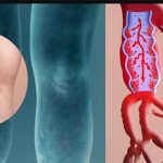 Trombosi venosa profonda (TVP) cause, fattori di rischio, sintomi e trattamenti naturali