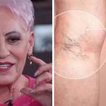 Trattamento raccomandato da Lidia Fecioru per le varici: Funziona anche per quelle interne