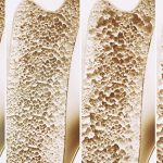 Osteoporosi: una minaccia in continua crescita, alimenti e esercizi fisici raccomandati