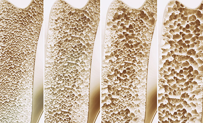 Osteoporosi: una minaccia in continua crescita, alimenti e esercizi fisici raccomandati