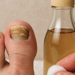 Come utilizzare l’aceto per liberarsi della micosi ungueale