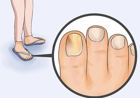 Tratta la micosi dell’unghia in modo naturale con l’acqua ossigenata: guida passo passo + consigli di prevenzione