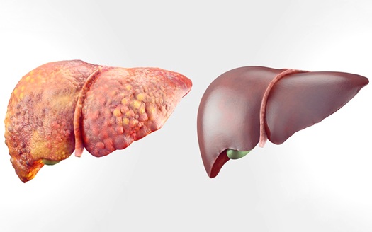 Pulizia del fegato in 7 giorni con tè e succhi naturali
