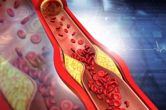 Un rimedio semplice per le arterie ostruite: il succo che combatte il colesterolo