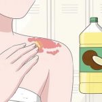 Come trattare i sintomi della psoriasi in modo naturale: 5 rimedi naturali efficaci