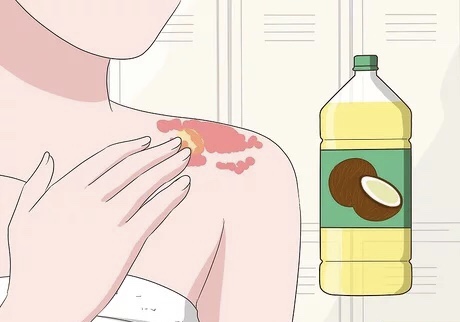 Come trattare i sintomi della psoriasi in modo naturale: 5 rimedi naturali efficaci