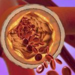 SUCCO NATURALE che ELIMINA il colesterolo e le TOXINE dal sangue! Bevi quotidianamente per arterie sane!