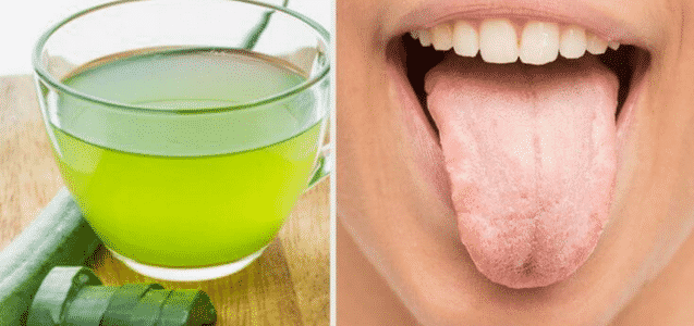 Lingua bianca (ncrcat) cause e rimedi naturali