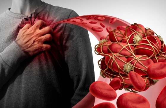 Top anticoagulanti naturali: Previn formarea cheagurilor și îmbunătățesc sănătatea inimii