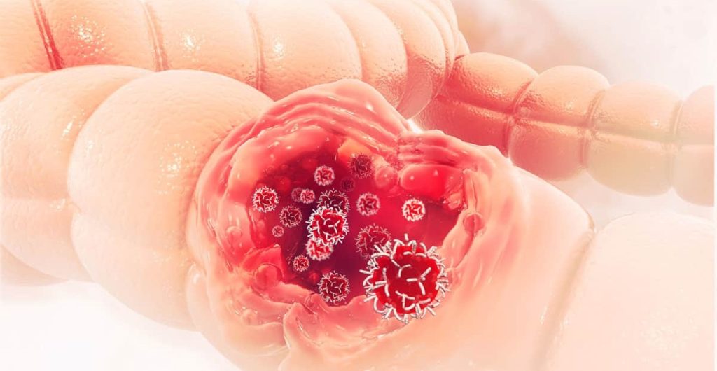 7 alimenti che riducono il rischio di cancro al colon, secondo le ricerche