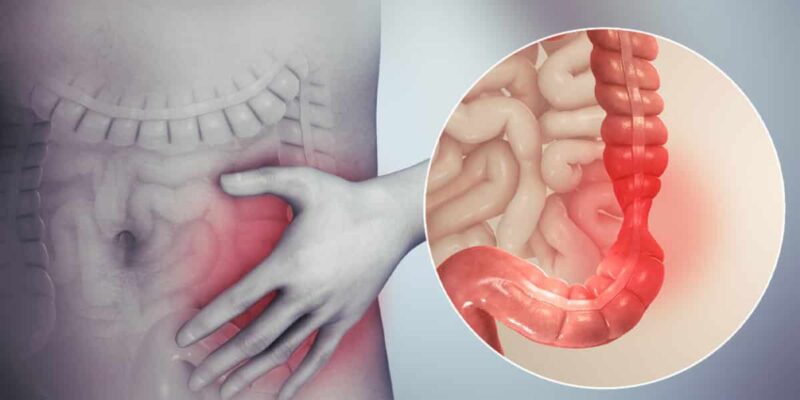 Tè per il colon irritabile, raccomandato da medici nutrizionisti