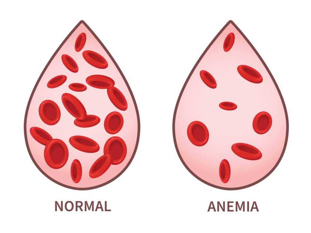 Alimenti per trattare l’anemia: perché dovrebbero essere evitati gli alimenti ricchi di calcio