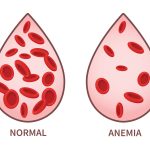 Alimenti per trattare l’anemia: perché dovrebbero essere evitati gli alimenti ricchi di calcio