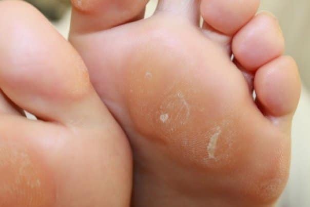 Come liberarsi da calli e duroni: i trattamenti naturali più efficaci