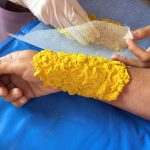 Cataplasma cu fin de muștar – încălzire profundă pentru dureri reumatice