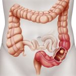 La tecnica Bowen per la sindrome dell’intestino irritabile: Una soluzione naturale per equilibrio e guarigione