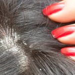 Dermatite seborroica: 5 rimedi naturali supportati da studi recenti