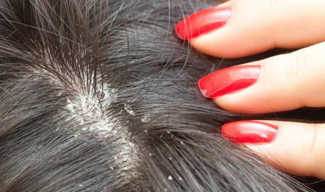 Dermatite seborroica: 5 rimedi naturali supportati da studi recenti