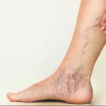 Rimedio a base di 3 piante per varici e gambe pesanti (ricetta e modalità d’uso)