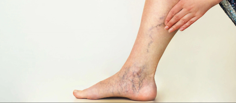 Rimedio a base di 3 piante per varici e gambe pesanti (ricetta e modalità d’uso)