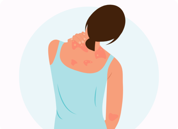 Ingredienti indispensabile in cucina che puoi usare per lavarti e che è buono per psoriasi ed eczemi