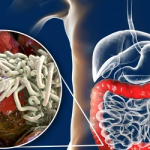 7 soluzioni naturali per eliminare i parassiti intestinali