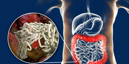 7 soluzioni naturali per eliminare i parassiti intestinali