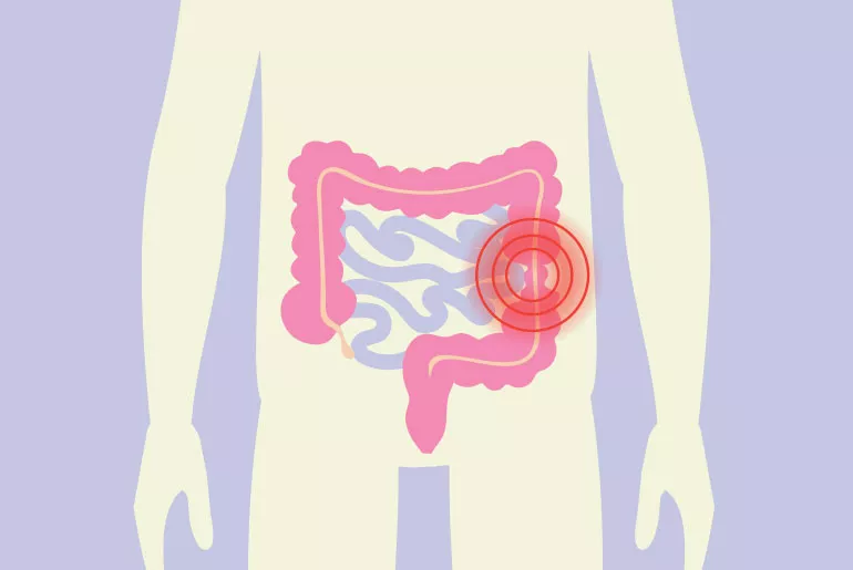 Plante per intestino irritabile combinazioni con effetto reale
