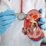 Il tè che scioglie la sabbia nei reni in modo naturale