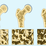 Rimedi naturali per l’osteoporosi: tè e tinture con effetti dimostrati (ricette e consumo)