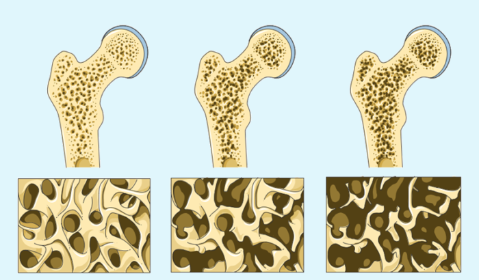Rimedi naturali per l’osteoporosi: tè e tinture con effetti dimostrati (ricette e consumo)