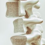 Trattamento dell’osteoporosi + 7 modi naturali per stimolare la densità ossea