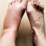 I migliori rimedi per le gambe gonfie: cosa dicono gli studi e i medici