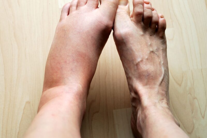 I migliori rimedi per le gambe gonfie: cosa dicono gli studi e i medici