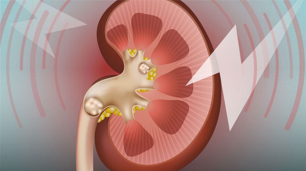 16 rimedi casalinghi per alleviare il dolore causato dai calcoli renali