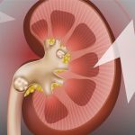 16 rimedi casalinghi per alleviare il dolore causato dai calcoli renali